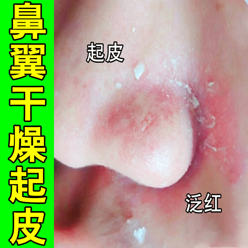 鼻翼干燥起皮泛红鼻头红血丝皮肤受损鼻子油腻长螨虫痘粗糙痒软膏