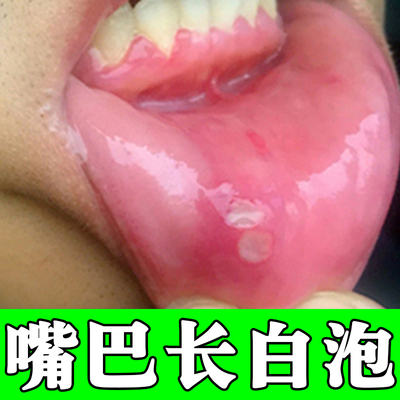 嘴巴内壁长白斑红肿灼热疼痛破口儿童成人上火嘴巴起白泡外用喷剂