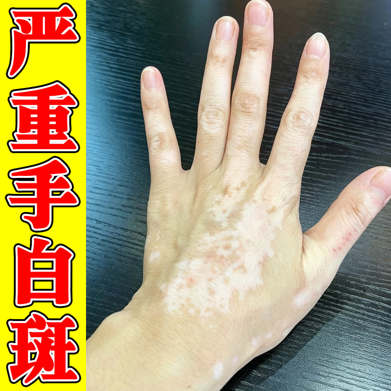 手上长白斑严重汗斑花斑修复促进黑色素生长专用手背白色斑块乳膏