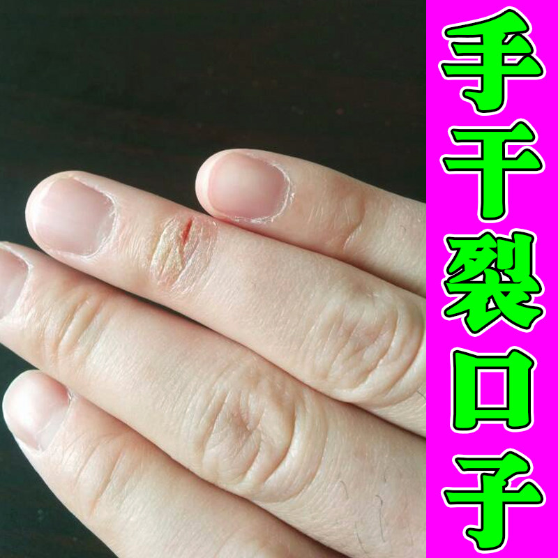 手干裂口子手指关节发痒干燥粗糙起皮掉屑真菌手脚脱皮裂口外用药