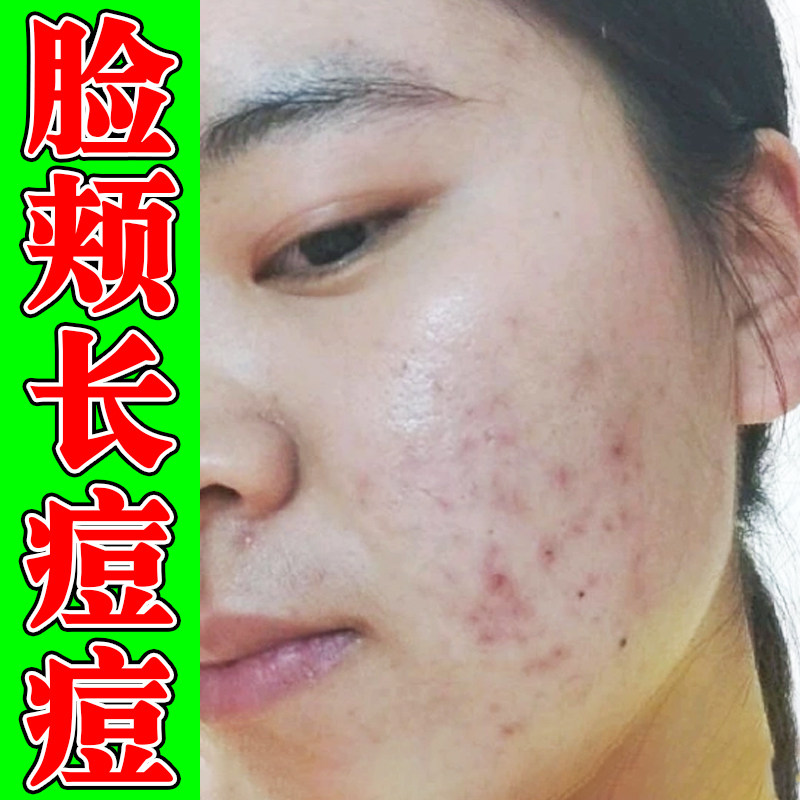 脸颊长痘痘额头痘下巴痘脸上长痘粉刺男女学生外用青春痘软膏