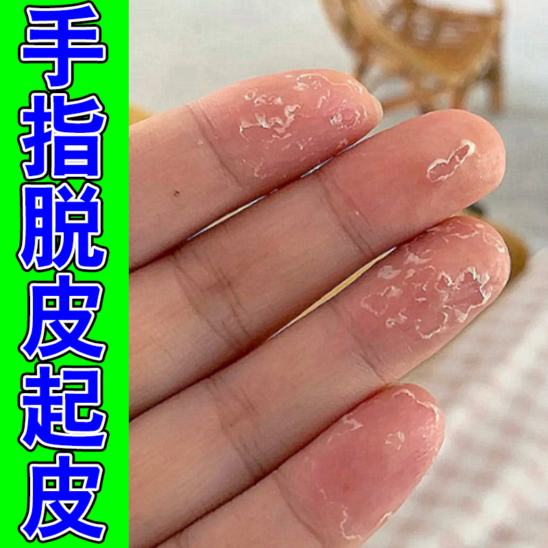 手脱皮专用干燥粗糙去死皮手指头起皮掉屑药季节性手蜕皮外用软膏