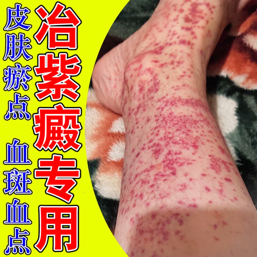 腿上身上起红点皮下出长小红点小腿长小红点色素沉淀软膏
