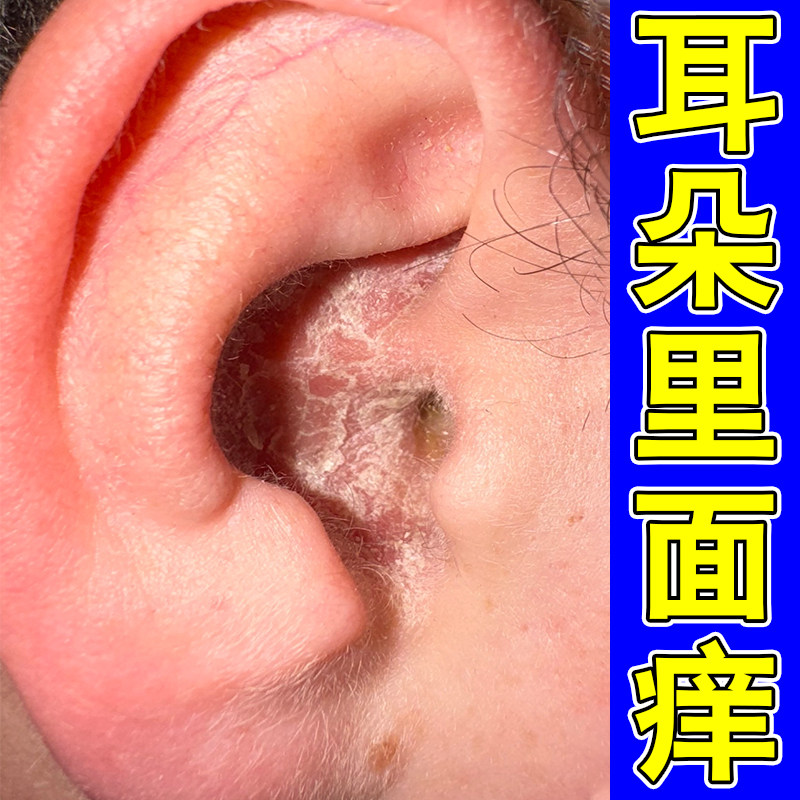 耳朵里面痒结痂干皮粗糙真菌外用外耳道干燥起皮屑痒红肿修复软膏