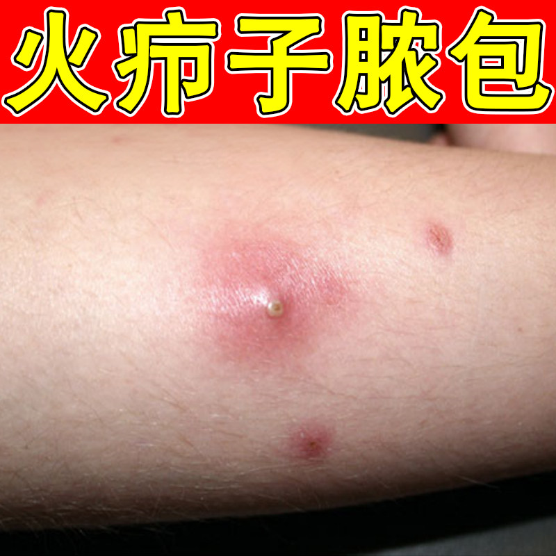 火疖子脓包药身上手臂长红肿疙瘩拔毒外用脓包硬块火疖子专用软膏