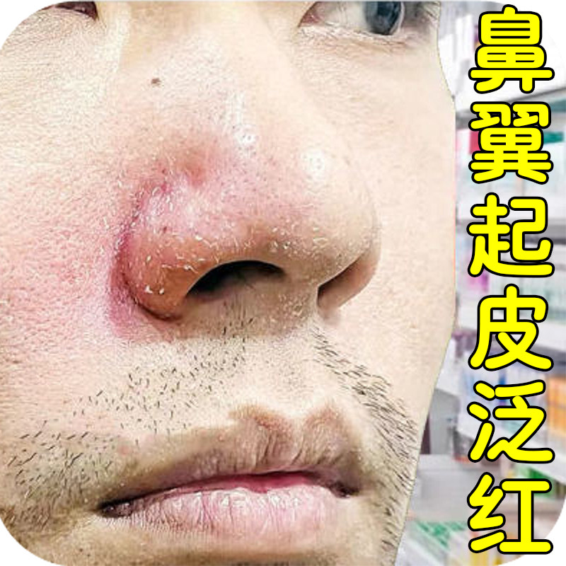 鼻子两边发红起皮屑鼻翼两侧发红干燥粗糙皮屑