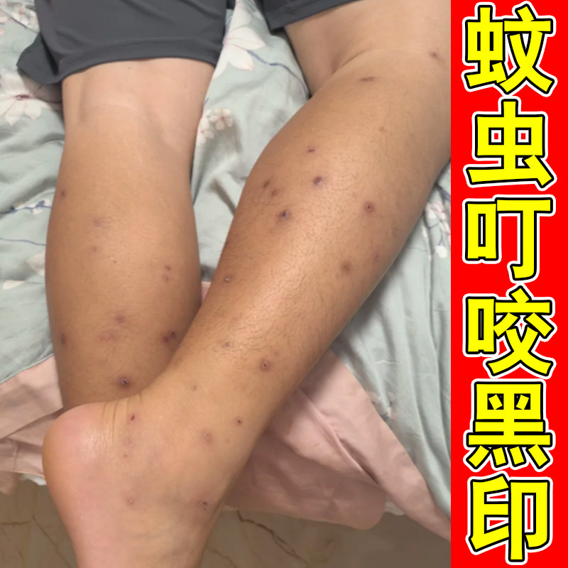 蚊虫叮咬黑印皮肤发黑淡化黑色素沉淀腿上挠印痘印伤烫疤痕黑印膏