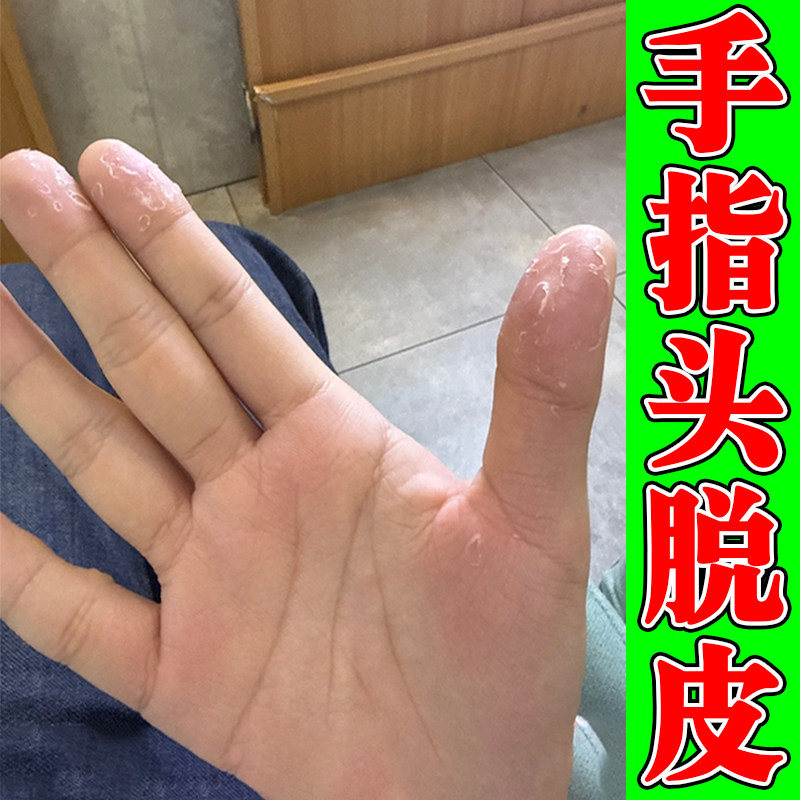 手指头脱皮起皮掉皮干燥粗糙手皮肤真菌季节性手脱皮专用软膏乳药
