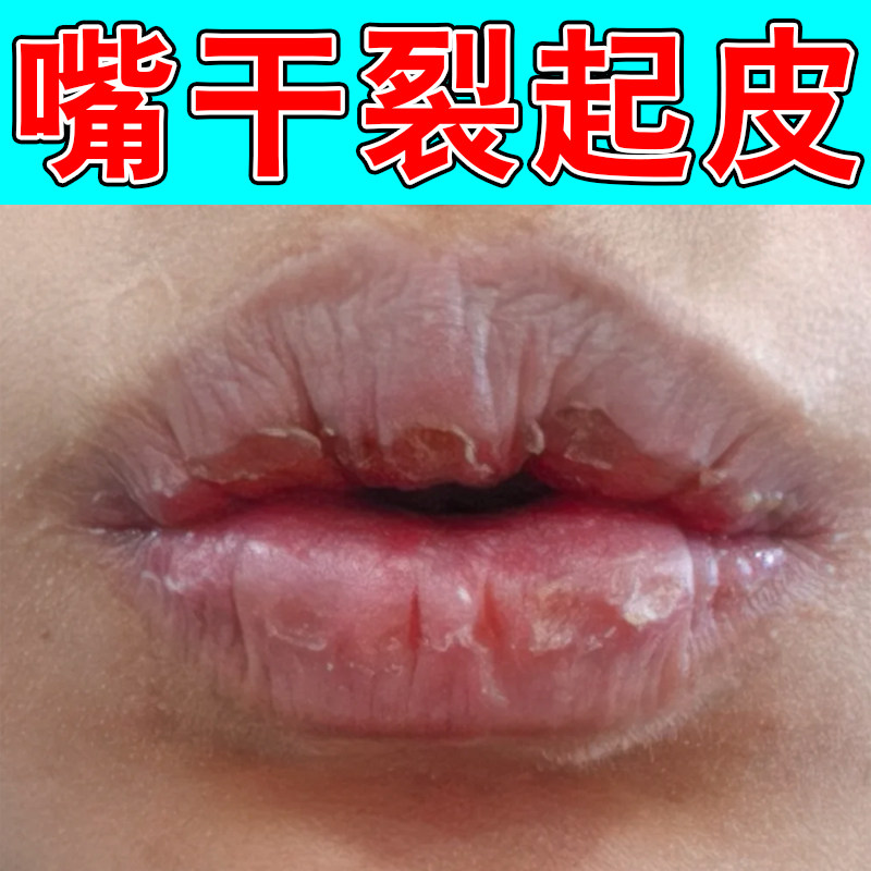嘴巴干燥起皮润唇膏补水保湿嘴唇掉干皮唇周紧绷秋冬唇干脱皮唇膏