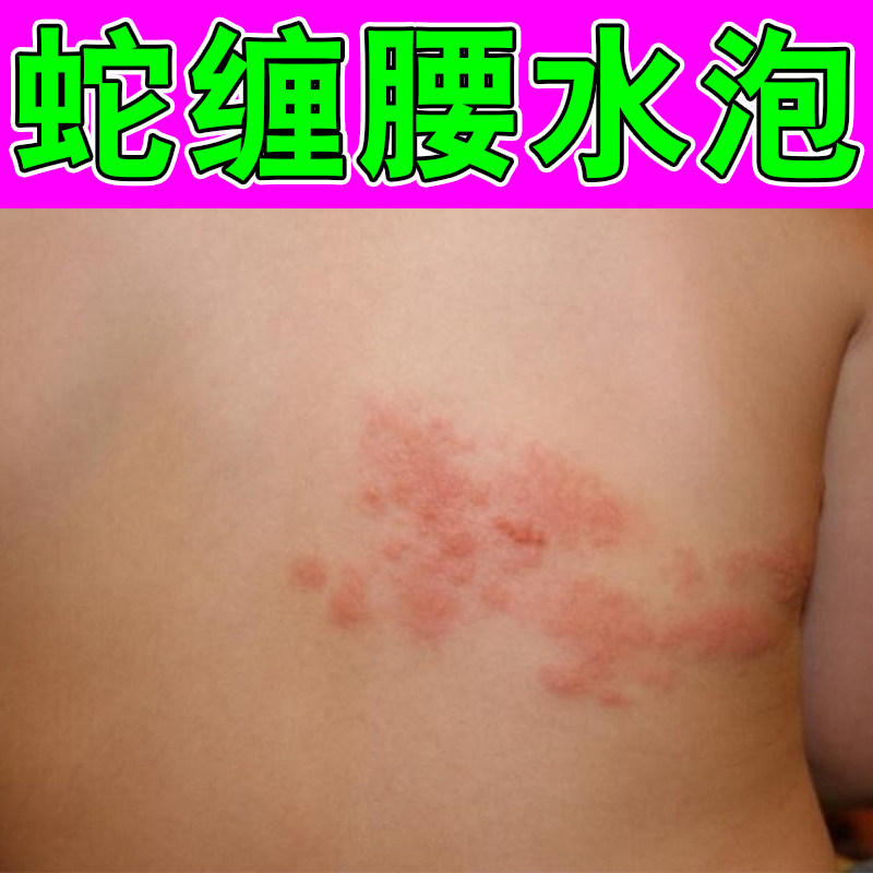 蛇缠腰红斑疙瘩疼痛神经带状蛇盘腰上长小水泡皮肤痒外用药