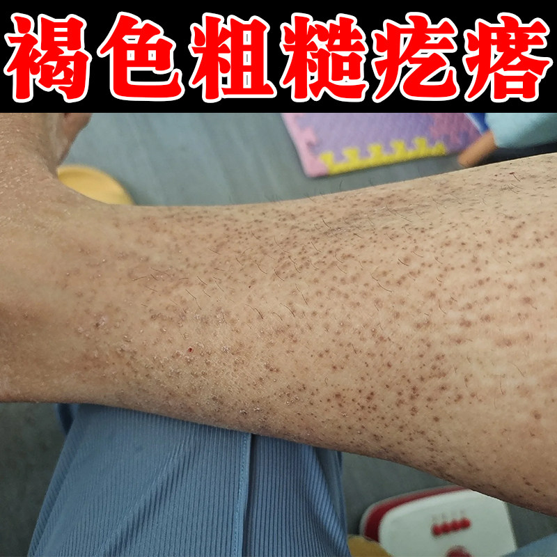 冶褐色粗糙疙瘩小腿皮肤黑色素沉淀干燥痒斑状颗粒蛋白沉积专用