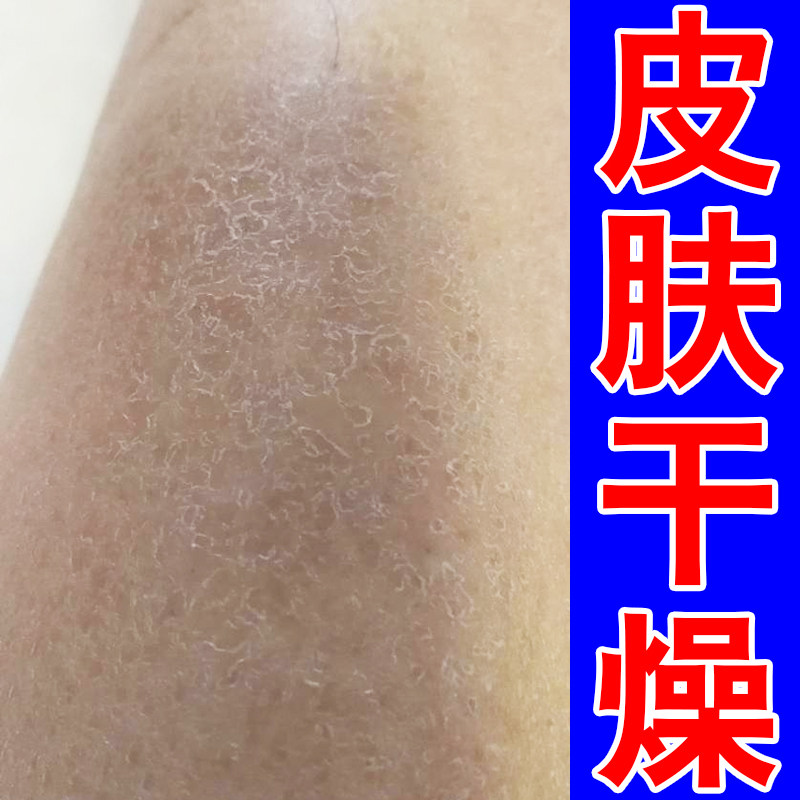 秋冬天小腿皮肤干燥起皮掉皮屑鱼鳞补水保湿修复润肤腿部皮肤干燥