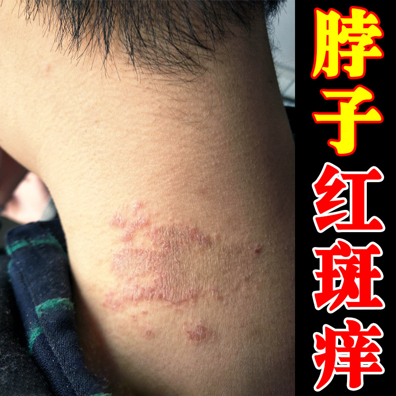 脖子后面痒红斑刺挠颈部过敏长小红点疙瘩神经性皮肤干痒专用膏药