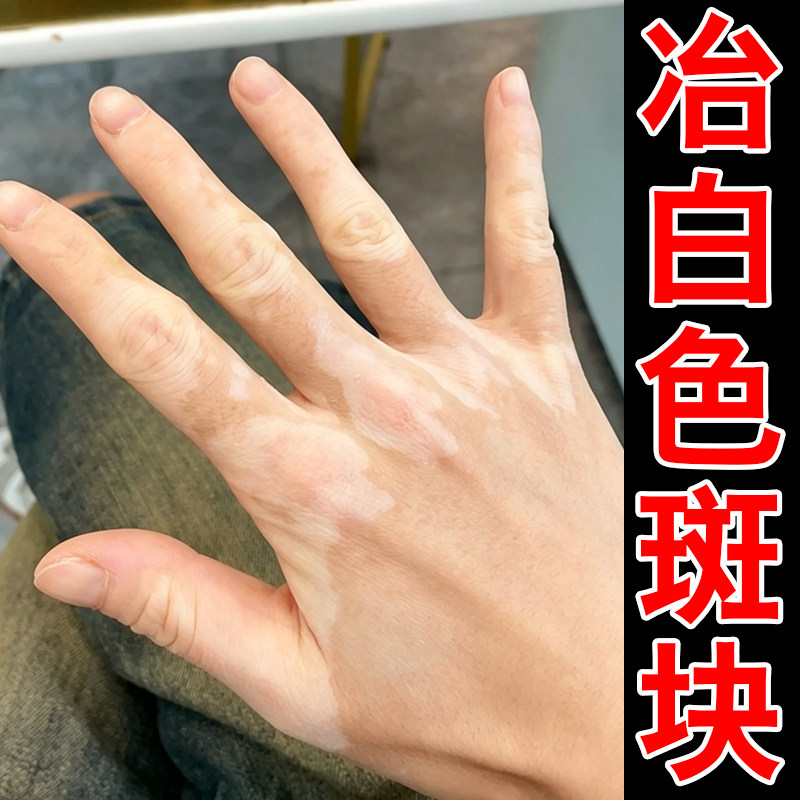 白色斑纹外用软膏手背手面长白斑修复药促进黑色素生长补骨脂酊