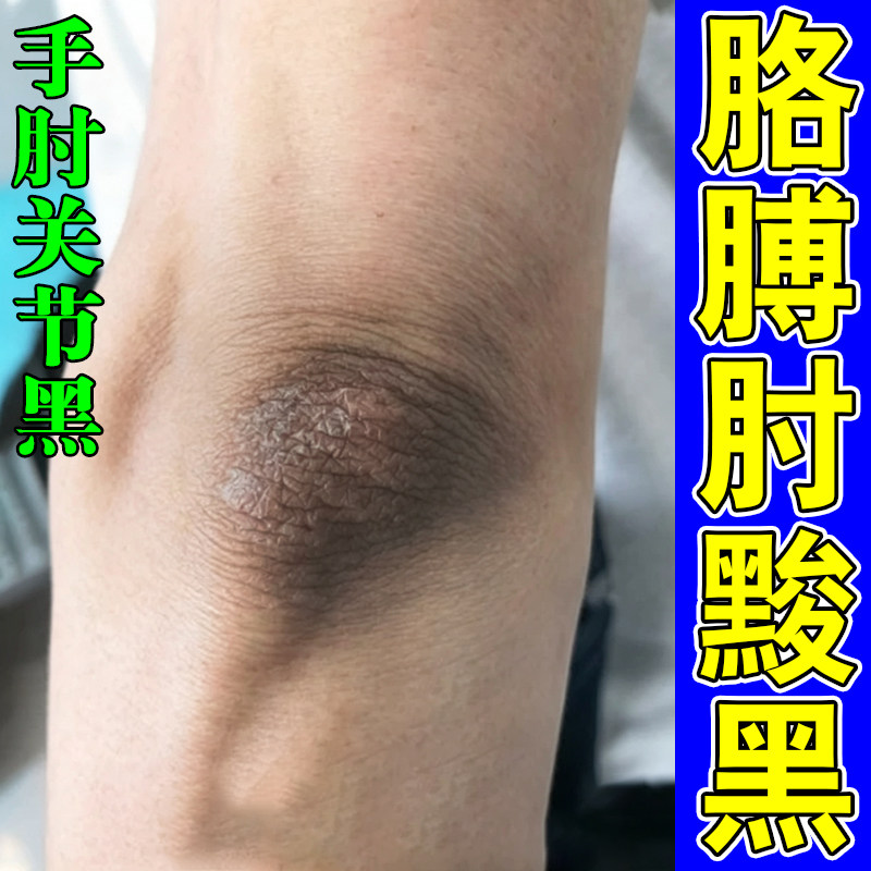 去胳膊肘黑死皮手肘干燥粗糙除脖子黑色素沉淀关节黑黑的洗不干净