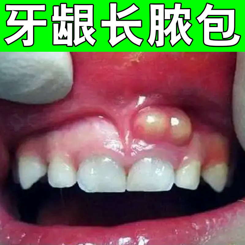 牙龈长脓包软疙瘩肉球肿痛专用喷雾剂牙根肿包疙瘩草本修复药
