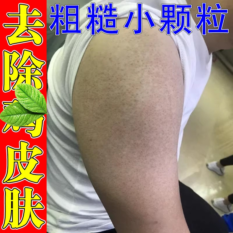 皮肤疙瘩全身腿部手臂脸部毛周毛囊胳膊长小颗粒疙瘩外用膏
