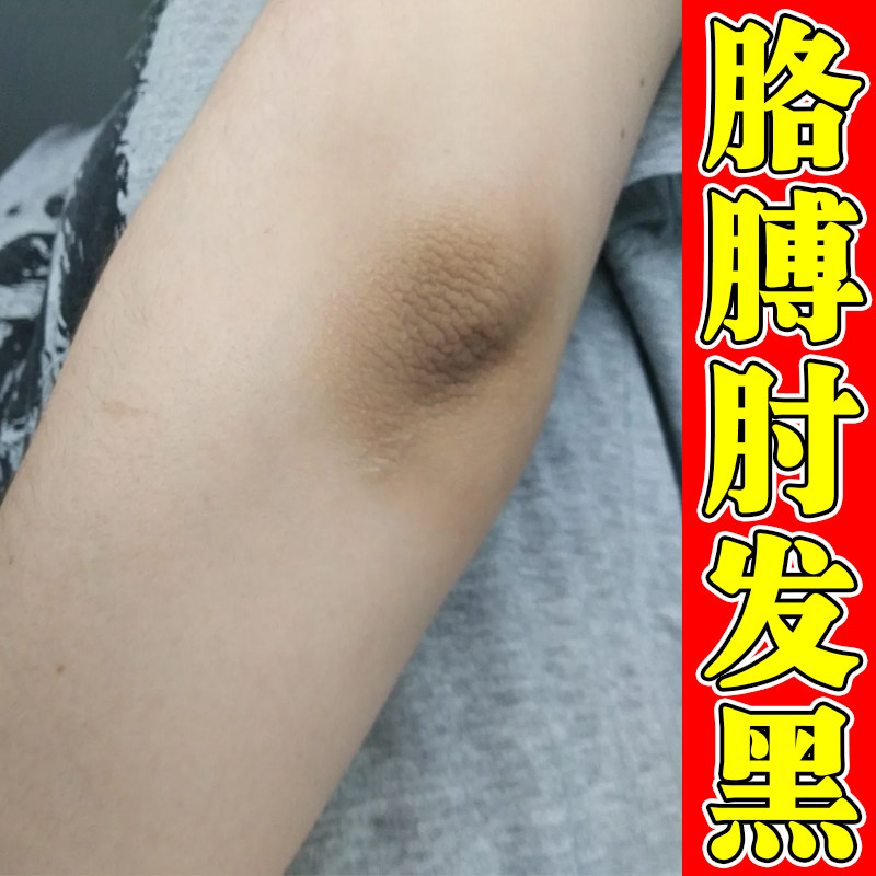 手肘黑脖子黑洗不干净神器去胳膊肘黑死皮肤黑色素沉淀除膝关节黑