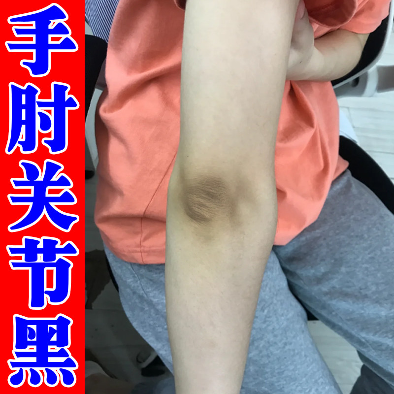 去手肘关节黑干燥粗糙死皮除胳膊肘去皮肤黑色素沉淀脖子膝盖黑