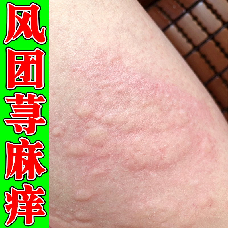 风团身上痒起红疙瘩皮肤过敏红肿痒小腿红斑疙瘩痘痘痒外用乳膏
