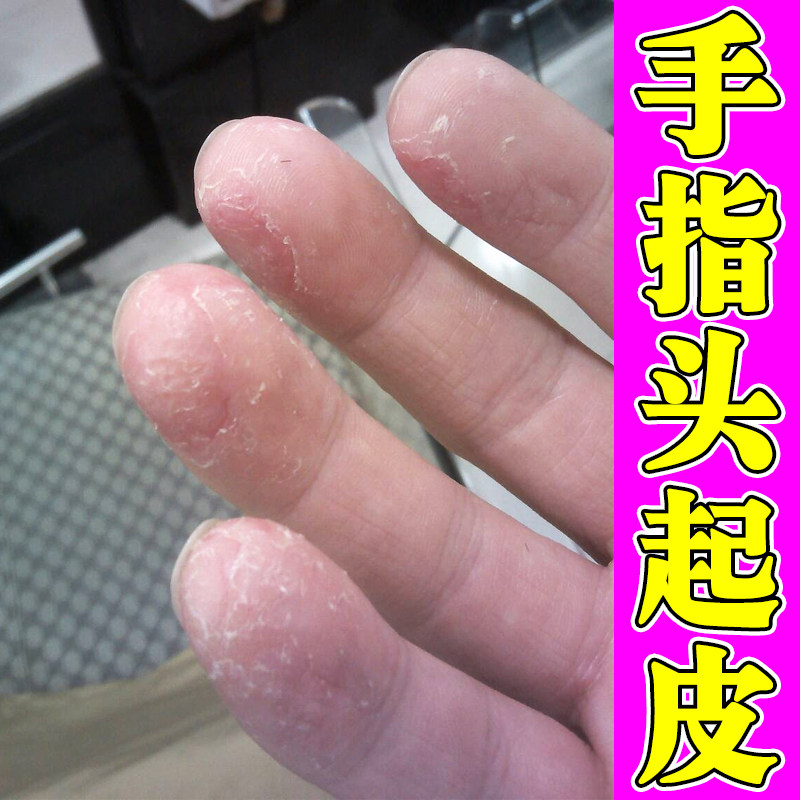 手严重脱皮专用真菌蜕皮干燥起皮药手脚后跟干裂修复霜手指头蜕皮