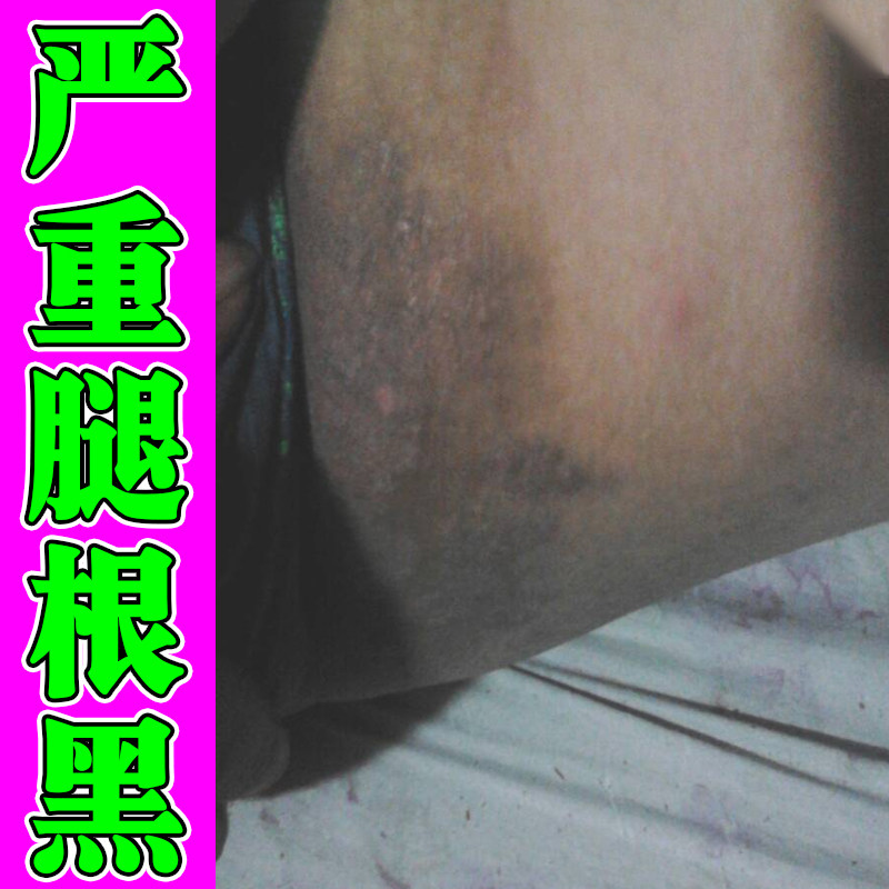 大腿内侧黑色素沉淀去腿两侧皮肤发黑洗不干净除脖子腋下手肘黑黑