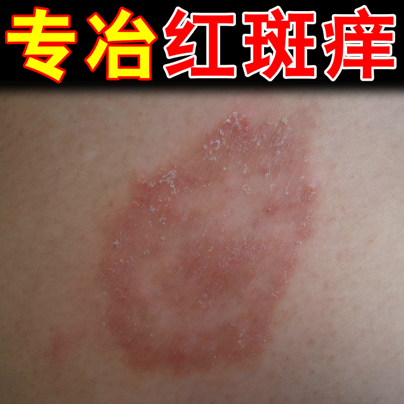 专冶人的猫红斑痒的药皮肤干燥粗糙起皮掉屑铜钱一挠就痒外用软膏