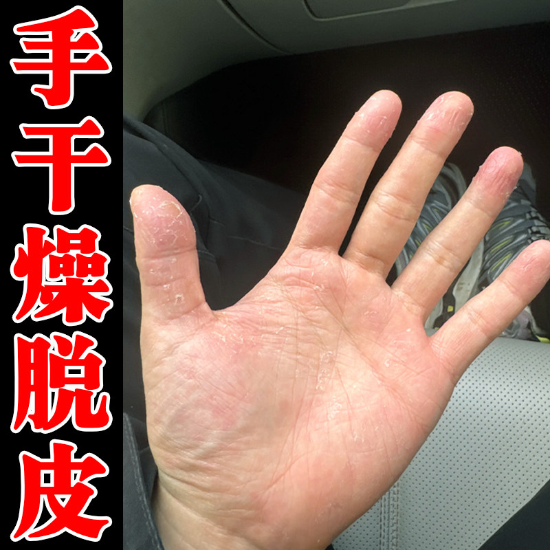 手干燥脱皮粗糙起皮专用软膏手指头手掌心蜕皮干裂真菌掉皮修复药