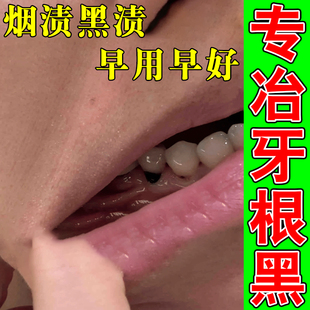 牙根发黑牙黄牙垢清除神器牙烟渍黑渍茶渍牙菌斑牙缝黑洗牙粉