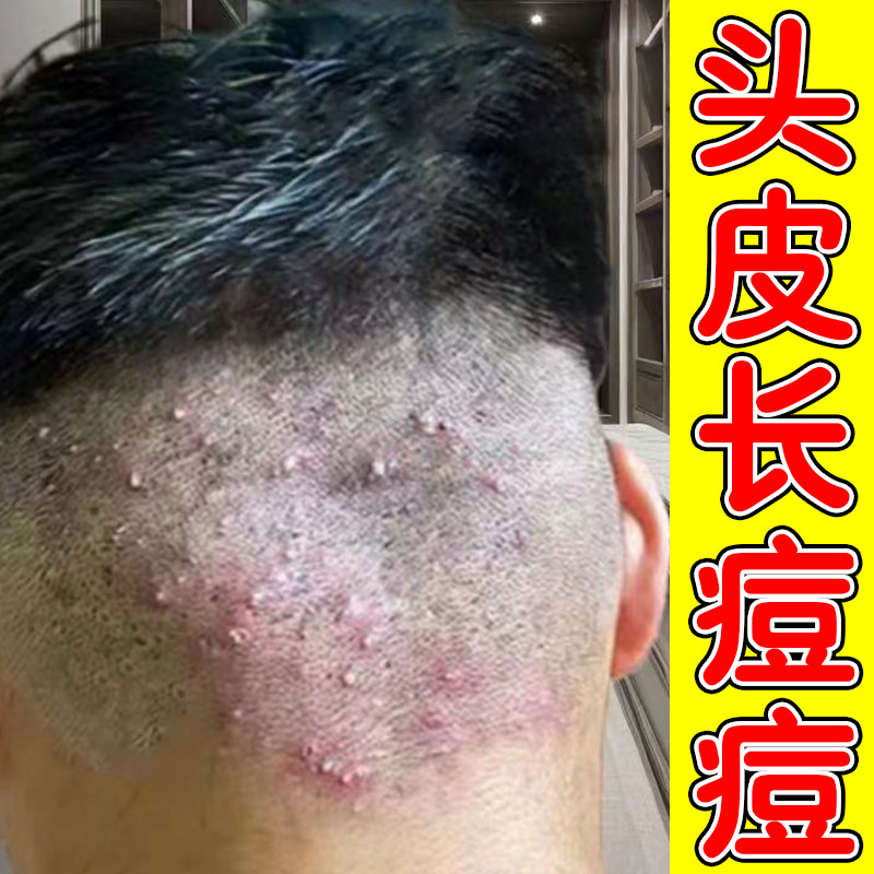 后脑勺头皮长疙瘩溢脂性皮肤痒毛囊红肿起红痘痘脖子上起脓包乳膏