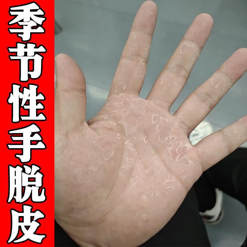 手指头起干皮真菌干燥粗糙起皮手足开裂口子手掌心手指蜕皮掉皮药