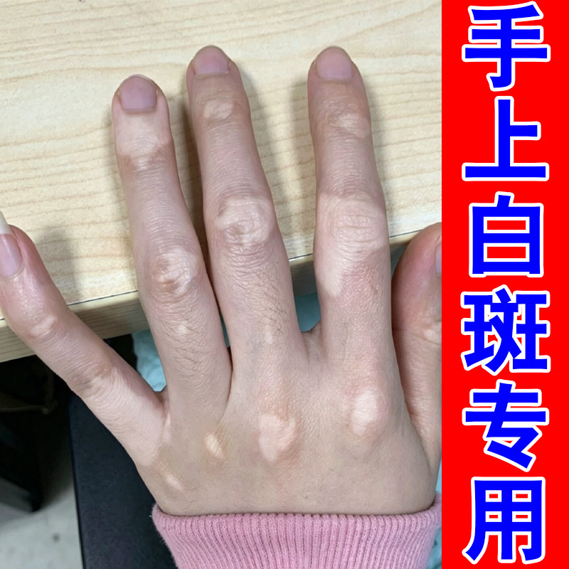 手上白斑专用促进黑色素生长外用修复手背身上皮肤长白色斑块汗斑