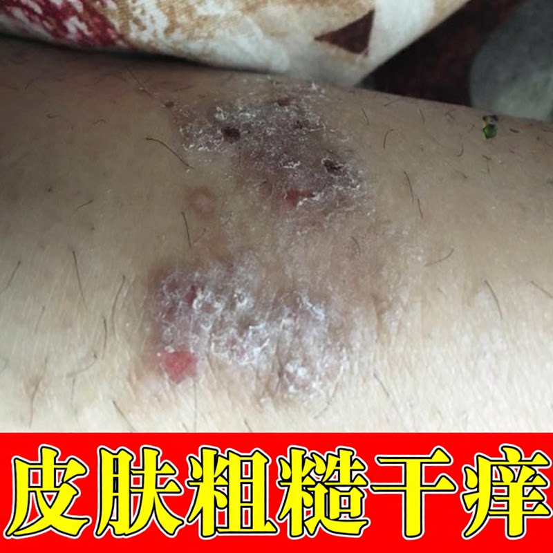 皮肤粗糙干痒红斑小疙瘩干燥起皮屑小腿痒腿上长小红点外用软膏药