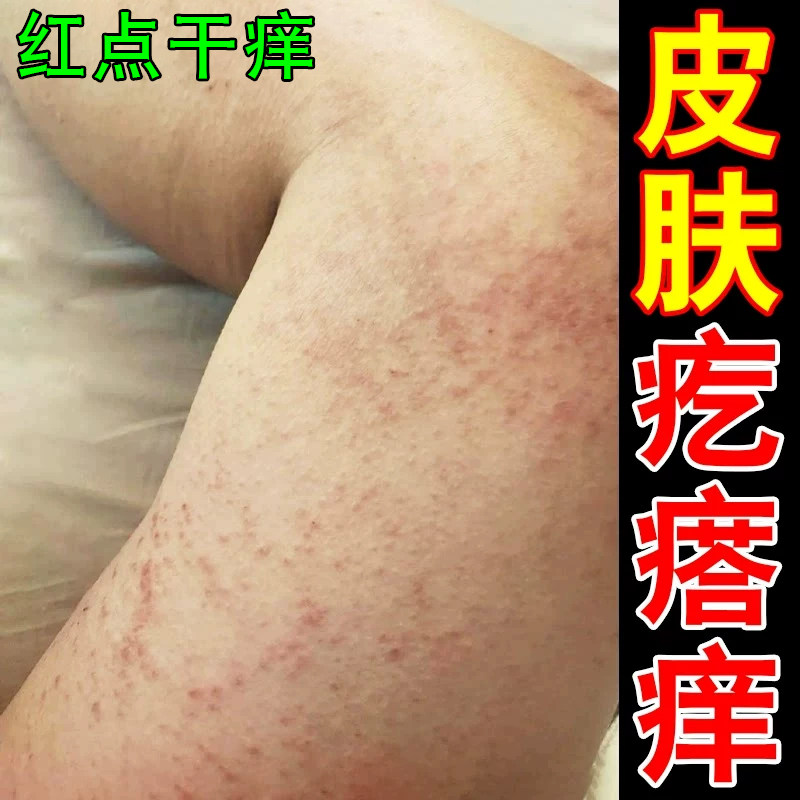身上痒起红疙瘩痒腿部皮肤痒软膏