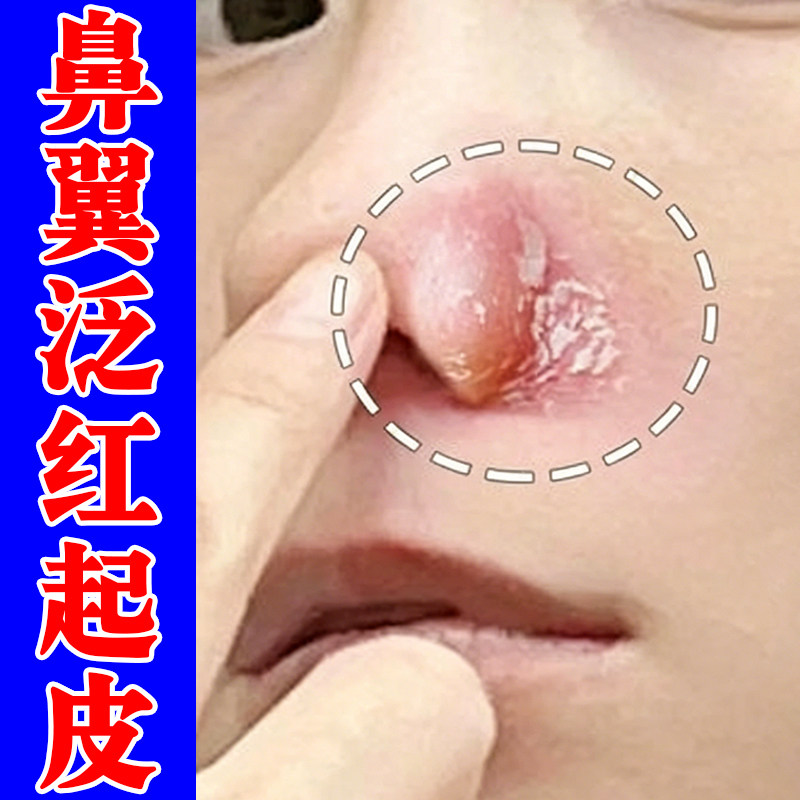 鼻翼泛红起皮干痒起螨虫痘外用药鼻子两边发红干燥粗糙痒修复软膏