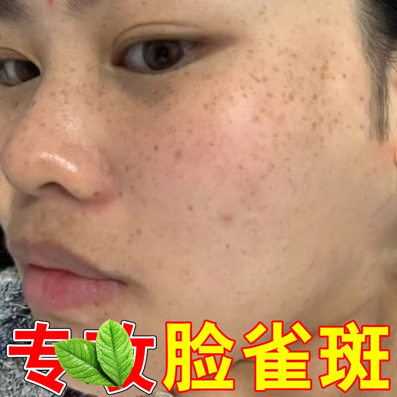 脸颊斑老年黑色素斑点脸上长斑斑满脸斑点膏