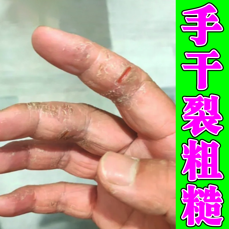 手干裂粗糙起皮手掌裂口发硬秋冬手部干燥疼真菌手指头裂口脱皮膏