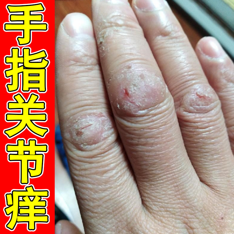 手指关节痒真菌干燥粗糙长硬疙瘩干裂脱皮接触性皮肤过敏痒软膏