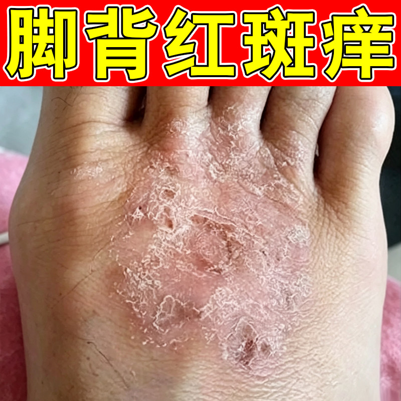 脚背红斑干痒起皮掉屑脚面皮肤过敏长小红点疙瘩干燥粗糙脚趾缝痒