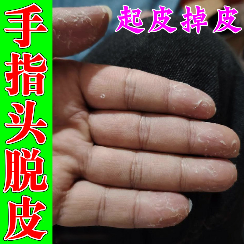 手指脱皮药干裂严重手指头脱皮蜕皮痒真菌感染干燥粗糙起皮专用膏
