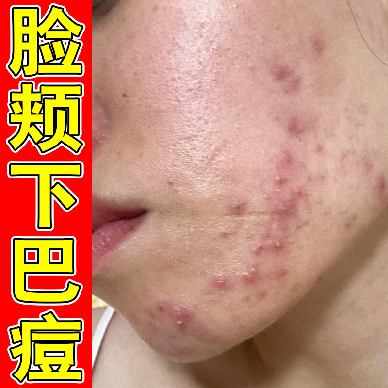 脸颊下巴痘腮边长痘痘红肿疙瘩闭口粉刺痘上火气痘青春痘药