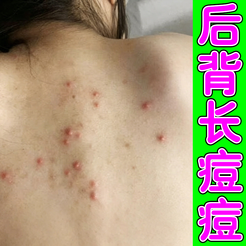 后背长痘前胸后背长痘痘毛囊炎马拉色菌红肿疙瘩螨虫痘