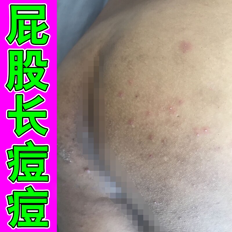 屁股痘痘专用膏冶大人屁股上长痘痘痒起热疙瘩慢性股久坐板红点痒