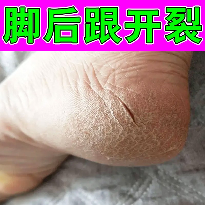 脚后跟干裂修复霜真菌脚干燥粗糙裂口子换季手足起硬皮脱皮专用膏