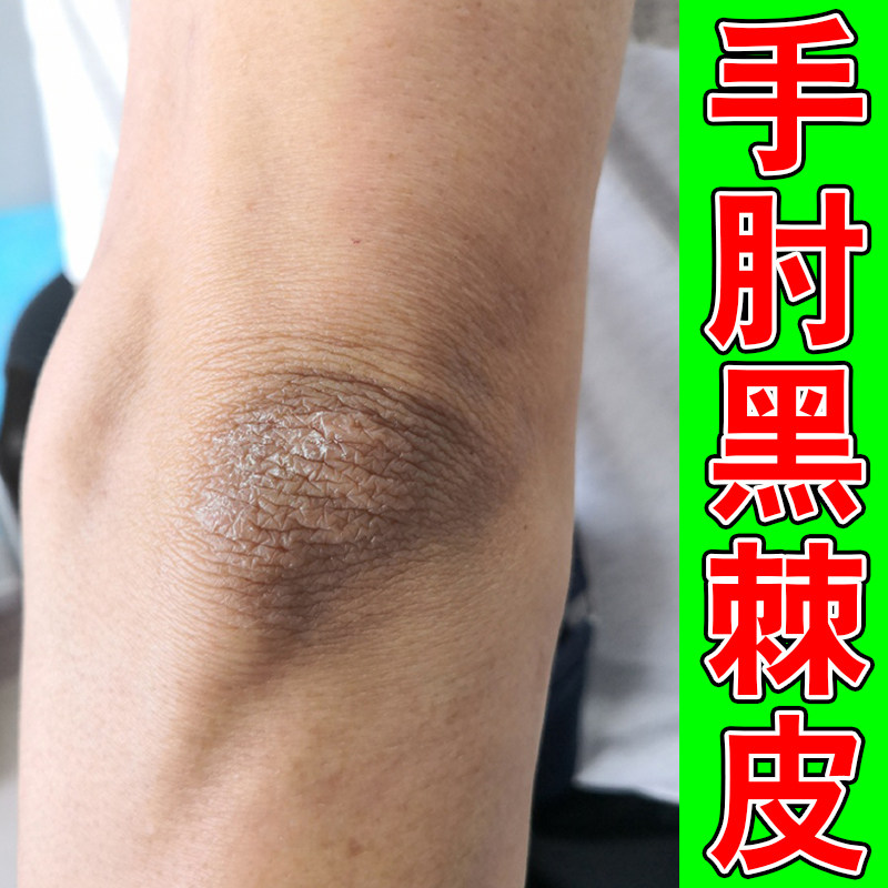 去胳膊肘黑皮肤黑色素沉淀除外用修复儿童成人脖子黑棘皮洗不干净