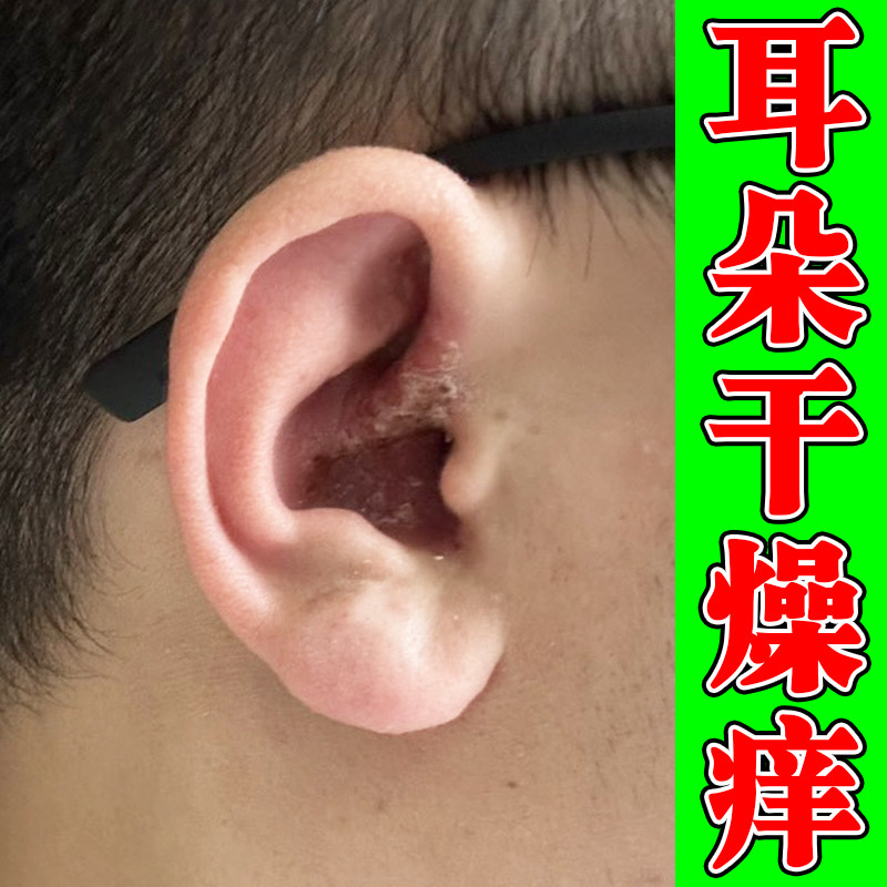 耳朵痒外用修复真菌耳朵里面痒干燥粗糙起皮掉屑结痂外耳道痒软膏