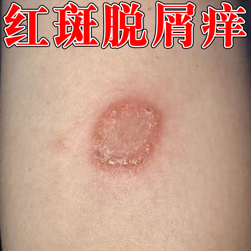 铜钱红斑脱屑痒身上手臂腿上长圆形金钱猫红斑疙瘩皮肤干燥粗糙痒