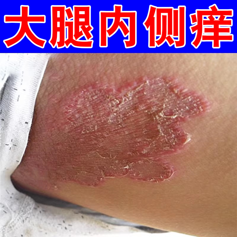 大腿内侧痒男士阴囊潮湿私处红斑疙瘩小红点干燥起皮掉屑痒外用膏