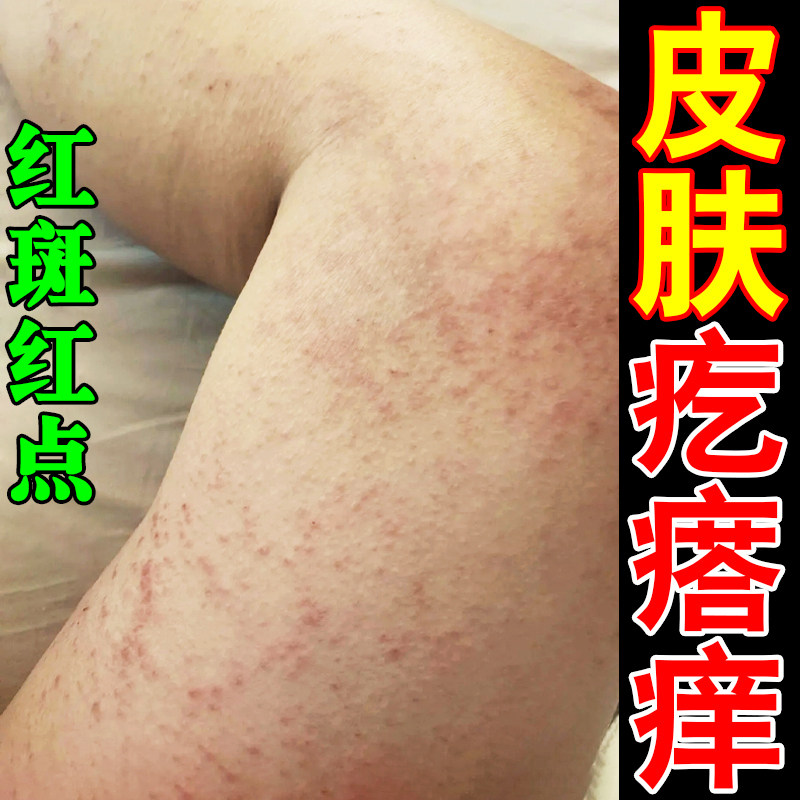 身上痒起红疙瘩痒腿部皮肤痒软膏