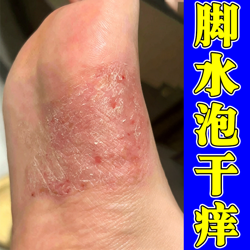 脚水泡干痒脚底粗糙起皮脱皮脚后跟干裂脚心泛红刺挠脚痒外用软膏
